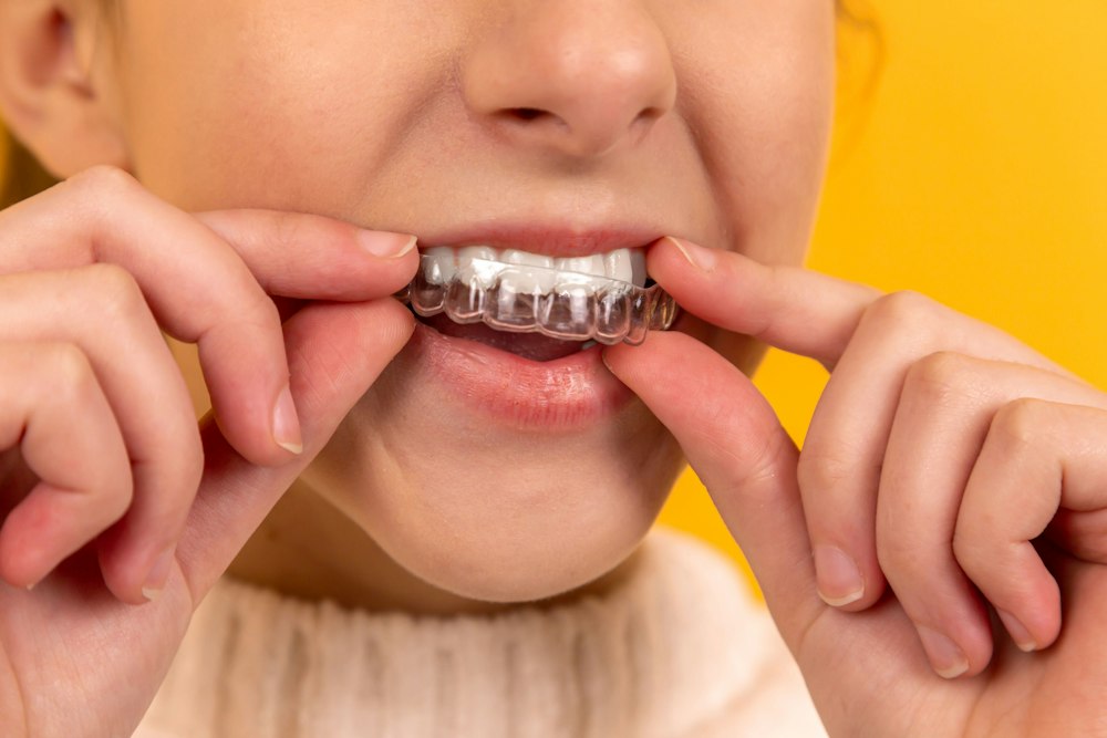 Clear aligner being placed on teeth